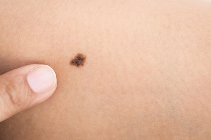 Early Signs of Melanoma or Other Skin Malignancies