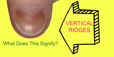 Do you have vertical ridges on your fingernails? This could signify…